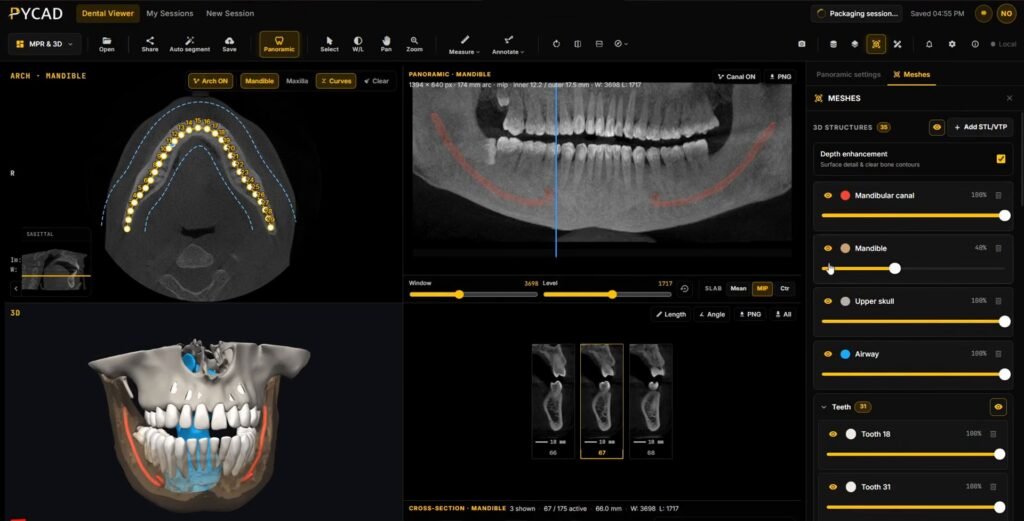 Full PYCAD Dental Viewer workspace after AI segmentation, with the arch on an axial slice, a panoramic with the mandibular canal traced in red, a 3D jaw with teeth, cross-sections, and a Meshes panel listing mandibular canal, mandible, upper skull, airway and teeth
