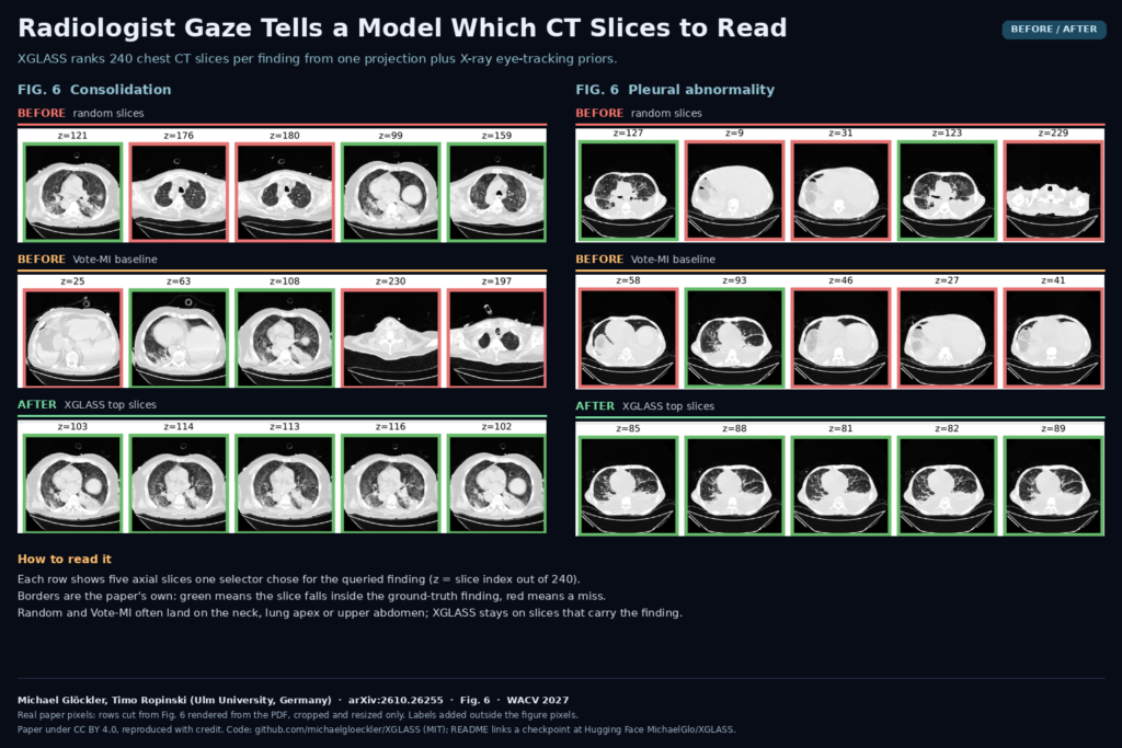 Figure 6 of arXiv:2610.26255 by Michael Glöckler and Timo Ropinski (Ulm University): five axial chest CT slices chosen by random selection, by Vote-MI and by XGLASS for consolidation and for pleural abnormality, with green borders on slices inside the ground-truth finding and red borders on misses.